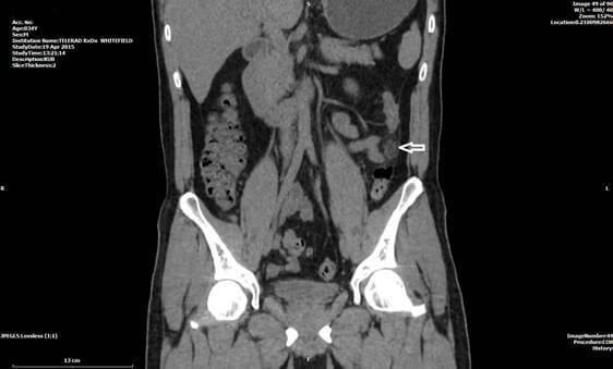 ct scan case of abdomen 2