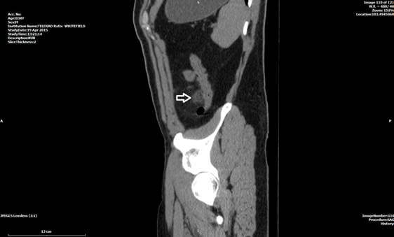 ct scan case of abdomen 