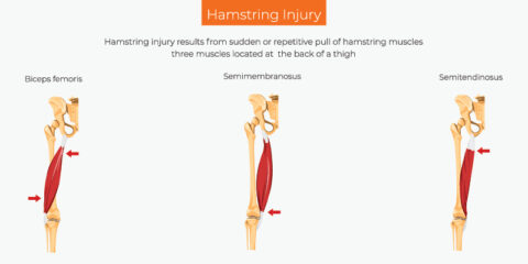 Hamstring Injury: Causes, Diagnosis & Treatment | RxDx