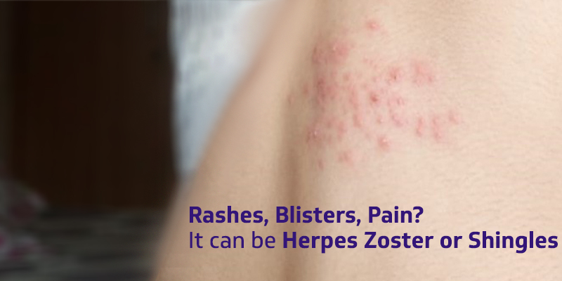 herpes zoster symptoms