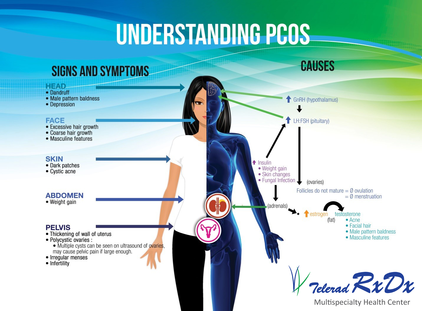 PCOS Signs Symptoms and Causes