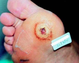 diabetic-sores-bottom-foot