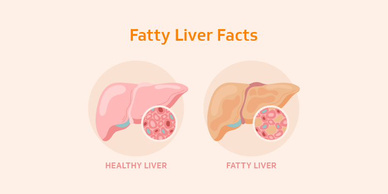 Fatty Liver Facts