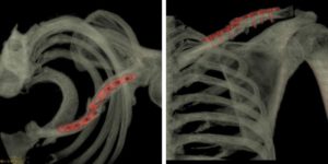 CT Scan-Refracture of Clavicle & Implant