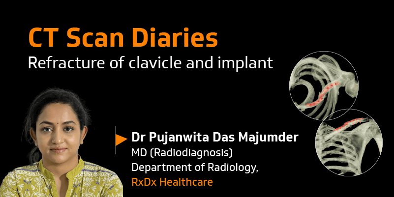 CT Scan Diaries: Refracture of clavicle and implant