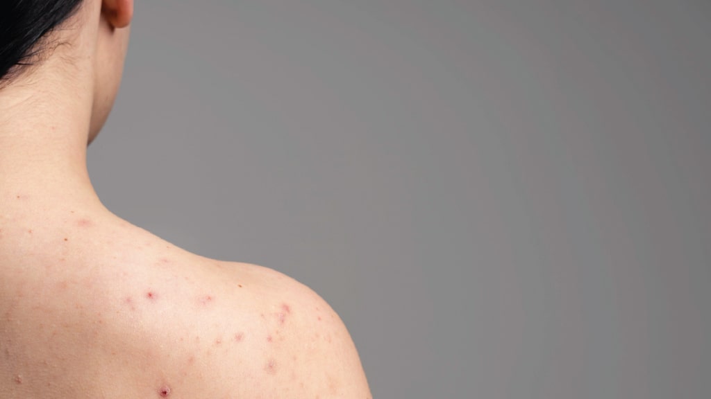 summer acne blog-01
