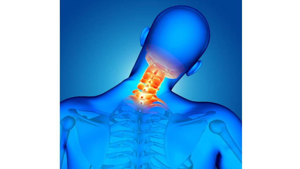 Understanding Cervical Spondylosis: A Physiotherapy Perspective