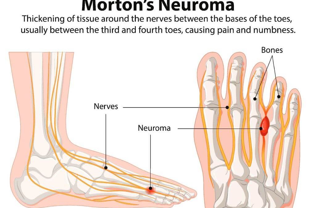 Mortons Neuroma