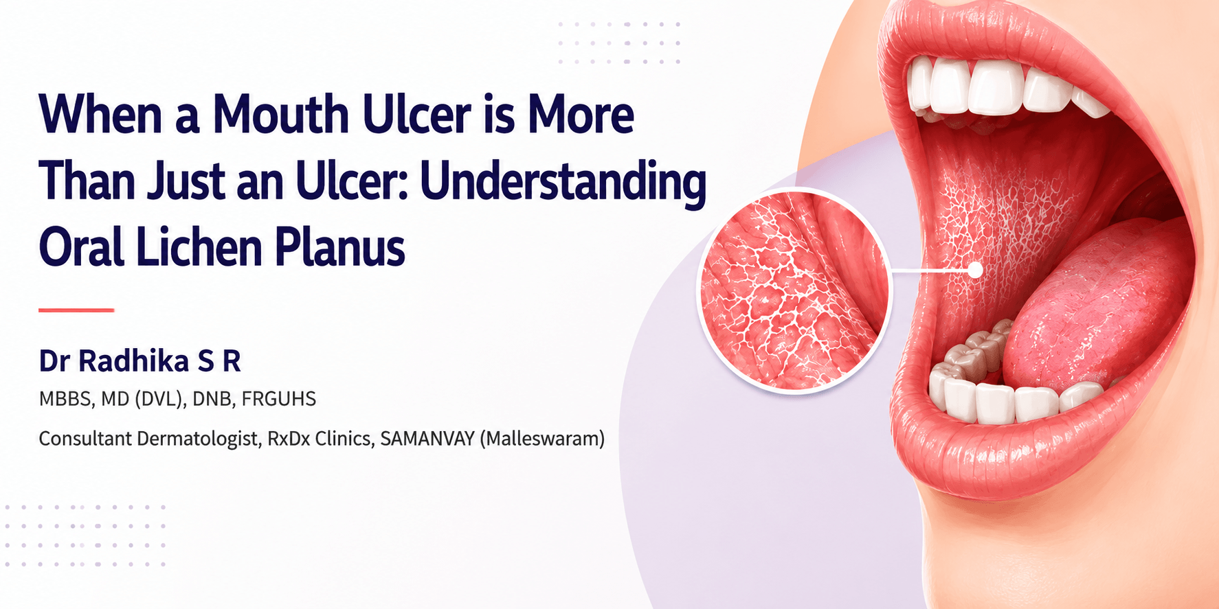 When a Mouth Ulcer Is More Than Just an Ulcer: Understanding Oral Lichen Planus