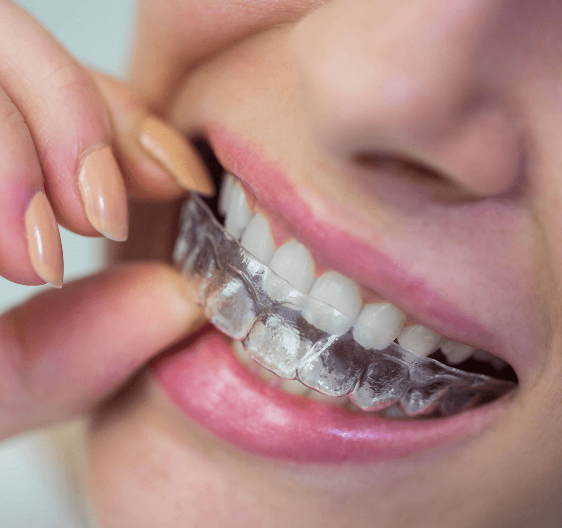Clear Aligners in Bengaluru